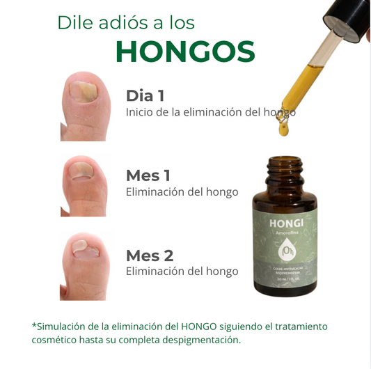 Gotas para Hongos de Uñas y Pies - Hongi Amorolfina 30 ml